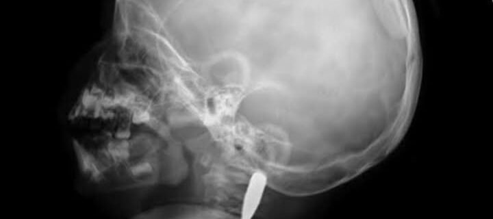 xray