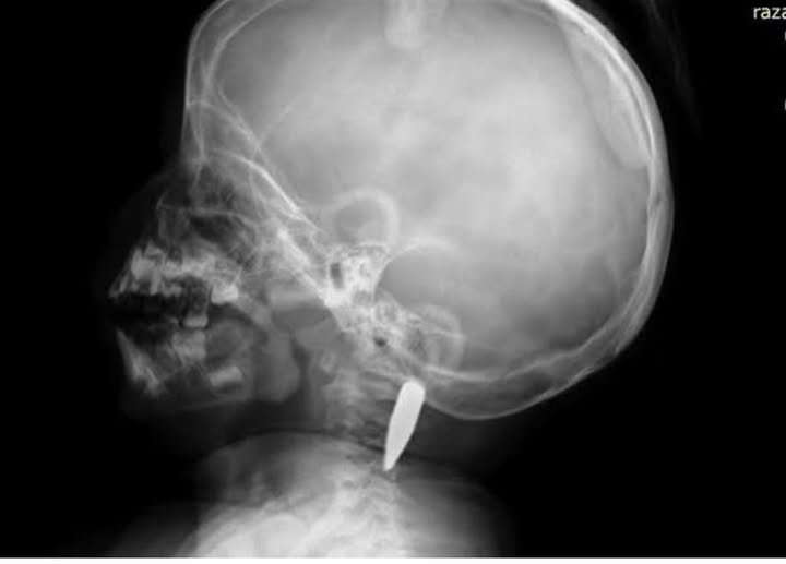 British neurosurgeon sharing about his most recent mission to Gaza